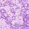 12B5 Ependymoma, anaplastic (Case 12) H&E 3