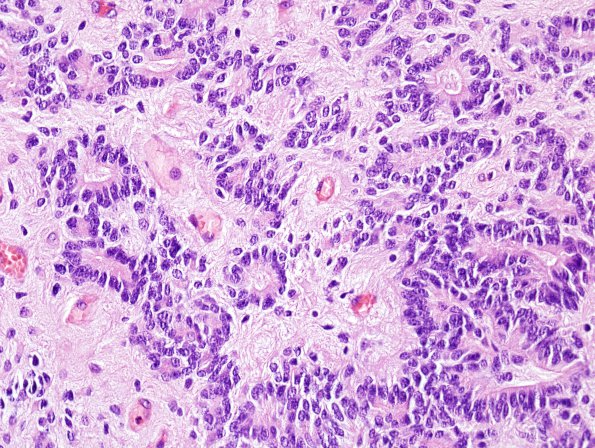 12B5 Ependymoma, anaplastic (Case 12) H&E 3