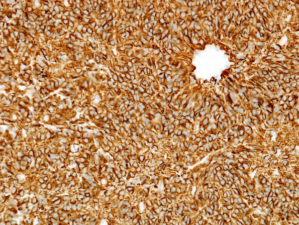 12C Ependymoma, anaplastic (Case 12) GFAP 2