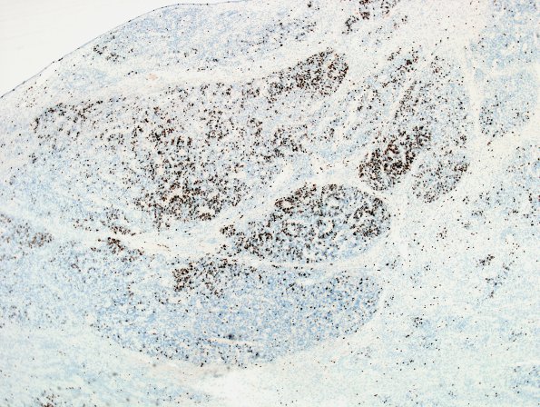 12D2 Ependymoma, anaplastic (Case 12) MIB 1