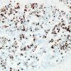 12D3 Ependymoma, anaplastic (Case 12) MIB 4