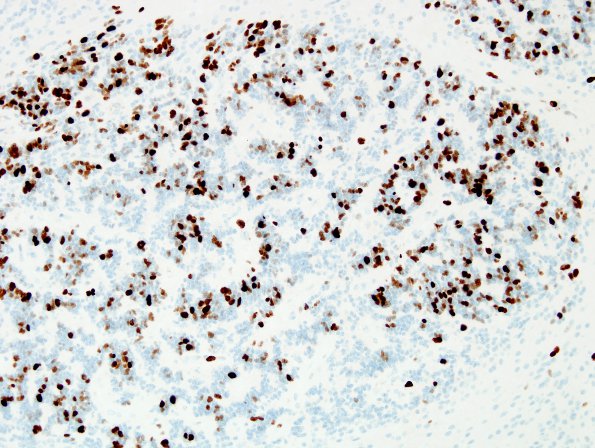 12D3 Ependymoma, anaplastic (Case 12) MIB 4