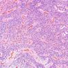 13A1 Ependymoma, anaplastic (Case 13) H&E 11