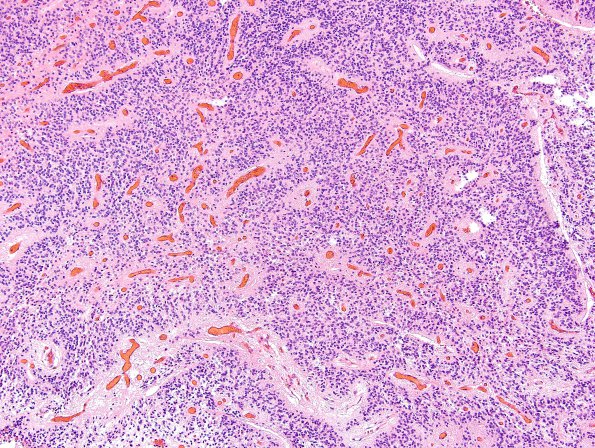 13A1 Ependymoma, anaplastic (Case 13) H&E 11