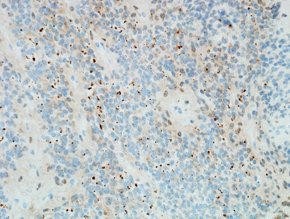 13C Ependymoma, anaplastic (Case 13) D2-40 1