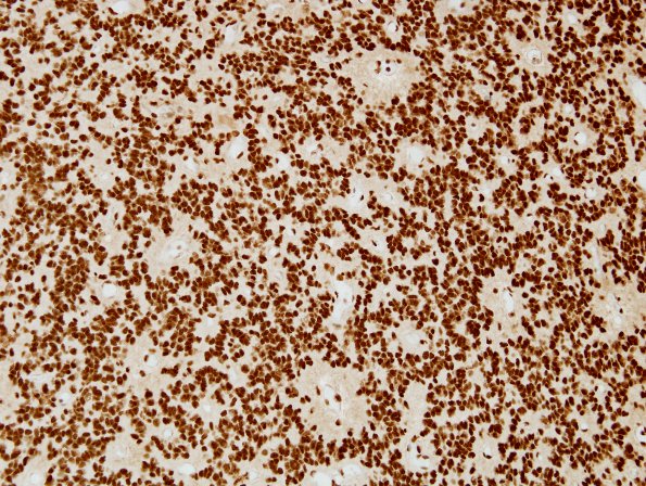 13D Ependymoma, anaplastic (Case 13) INI1