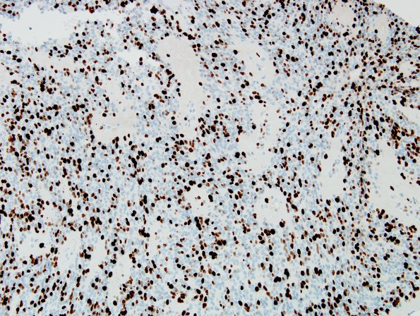 13E Ependymoma, anaplastic (Case 13) MIB1