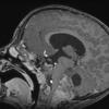 14A1 Ependymoma, Anaplastic (Case 14) T1 MPRAGE W 2 - Copy