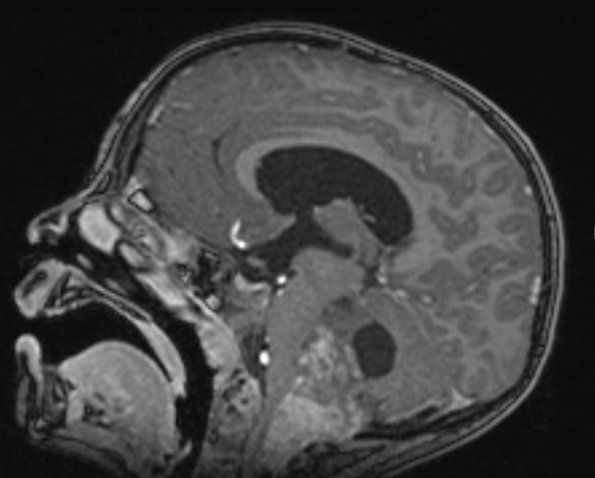 14A1 Ependymoma, Anaplastic (Case 14) T1 MPRAGE W 2 - Copy