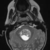 14A2 Ependymoma, Anaplastic (Case 14) T2 W - Copy - Copy