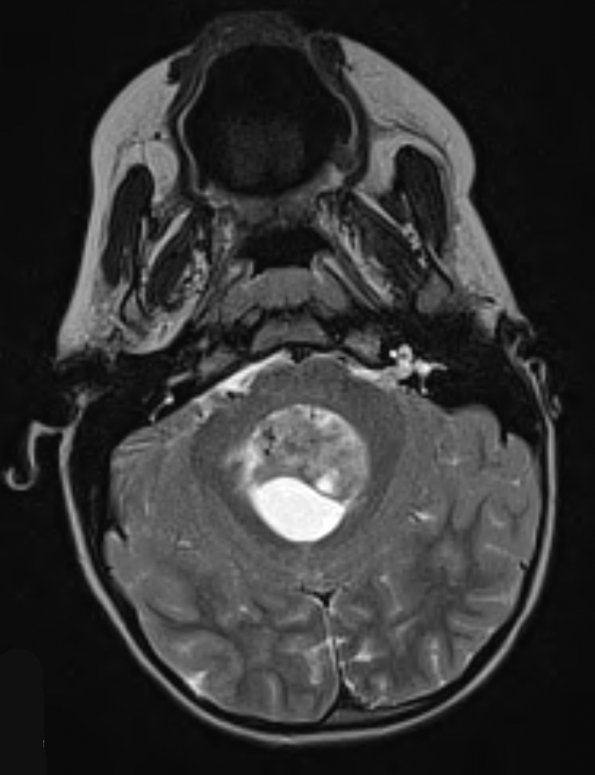 14A2 Ependymoma, Anaplastic (Case 14) T2 W - Copy - Copy