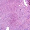 14B1 Ependymoma, Anaplastic (Case 14) H&E 17