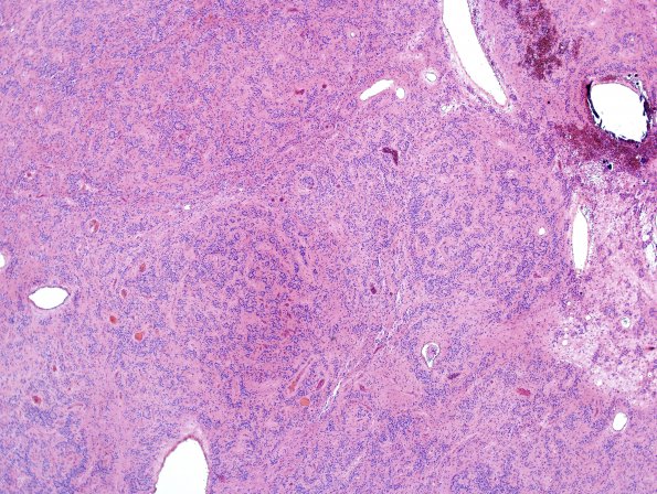 14B1 Ependymoma, Anaplastic (Case 14) H&E 17