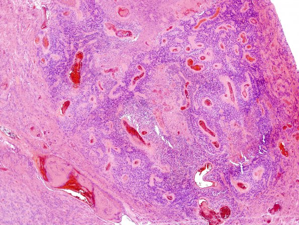 14B2 Ependymoma, Anaplastic (Case 14) H&E 18