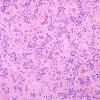 14B3 Ependymoma, Anaplastic (Case 14) H&E 1