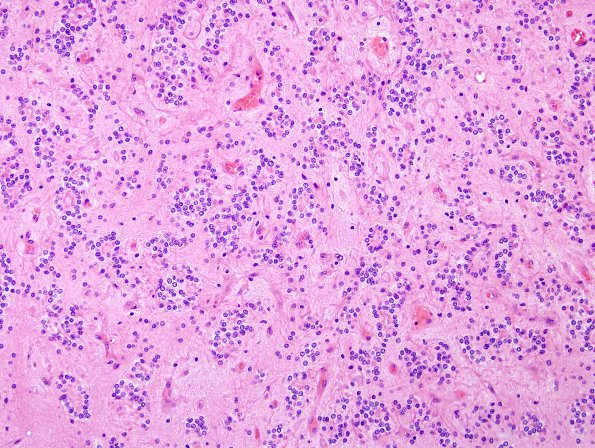 14B3 Ependymoma, Anaplastic (Case 14) H&E 1