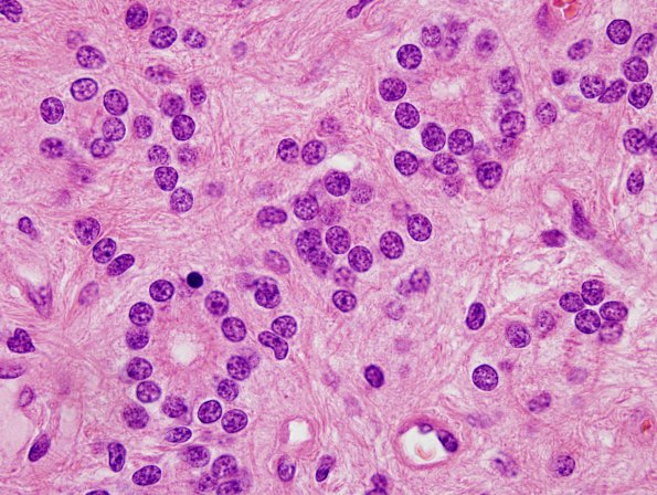 14B4 Ependymoma, Anaplastic (Case 14) H&E 9