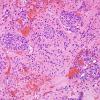 14B5 Ependymoma, Anaplastic (Case 14) H&E 5