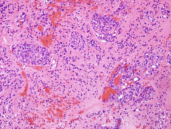 14B5 Ependymoma, Anaplastic (Case 14) H&E 5