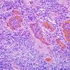 14B6 Ependymoma, Anaplastic (Case 14) H&E 20