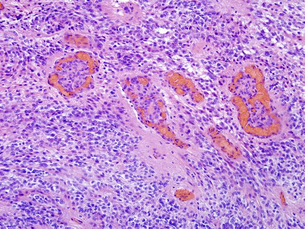 14B6 Ependymoma, Anaplastic (Case 14) H&E 20