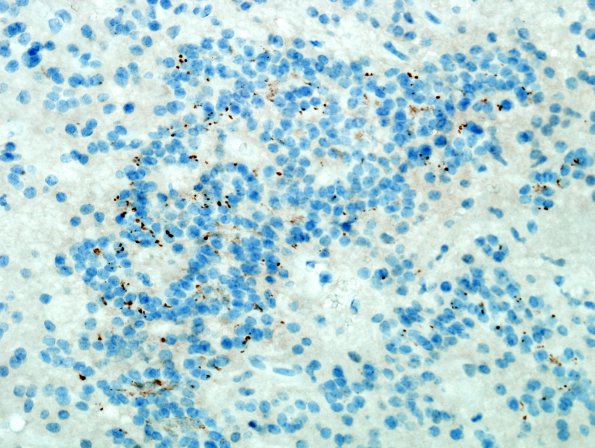 14D Ependymoma, Anaplastic (Case 14) D2-40 1