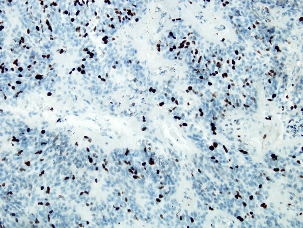 14E Ependymoma, Anaplastic (Case 14) MIB 2