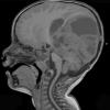 15A1 Ependymoma, anaplastic (Case 15) T1 - Copy