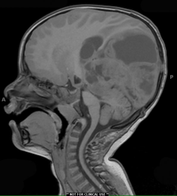 15A1 Ependymoma, anaplastic (Case 15) T1 - Copy