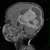 15A2 Ependymoma, anaplastic (Case 15) T1 W 3 - Copy