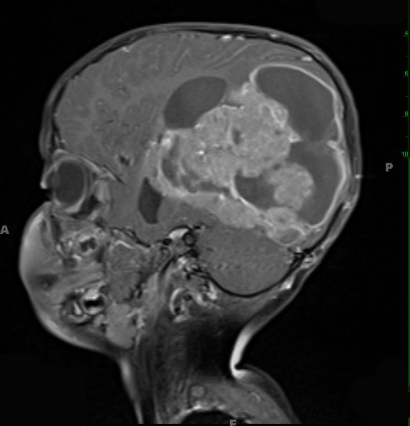 15A2 Ependymoma, anaplastic (Case 15) T1 W 3 - Copy