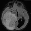 15A3 Ependymoma, anaplastic (Case 15) FLAIR - Copy