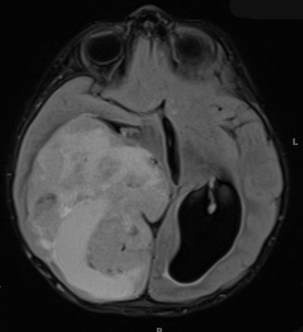 15A3 Ependymoma, anaplastic (Case 15) FLAIR - Copy