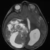 15A4 Ependymoma, anaplastic (Case 15) T2 W - Copy