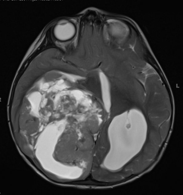 15A4 Ependymoma, anaplastic (Case 15) T2 W - Copy