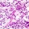 15B1 Ependymoma, anaplastic (Case 15) H&E smear 1.jpg