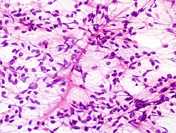 15B1 Ependymoma, anaplastic (Case 15) H&E smear 1.jpg