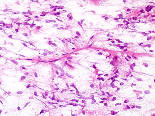 15B2 Ependymoma, anaplastic (Case 15) H&E smear 3.jpg