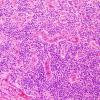 15B3 Ependymoma, anaplastic (Case 15) H&E 9.jpg