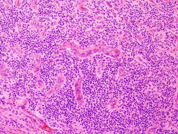 15B3 Ependymoma, anaplastic (Case 15) H&E 9.jpg