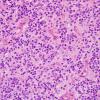 15B4 Ependymoma, anaplastic (Case 15) H&E 8.jpg