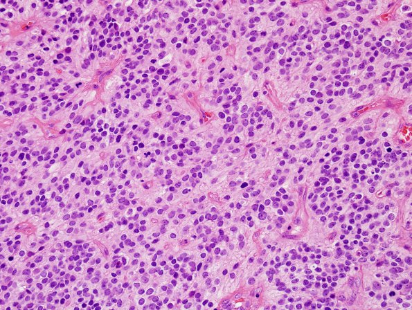 15B4 Ependymoma, anaplastic (Case 15) H&E 8.jpg