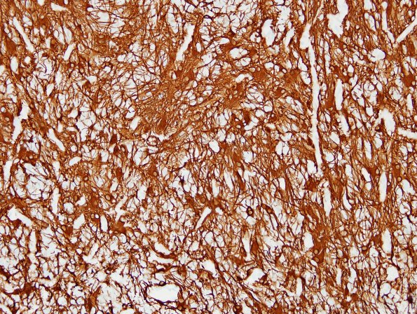 15C Ependymoma, anaplastic (Case 15) GFAP 3.jpg