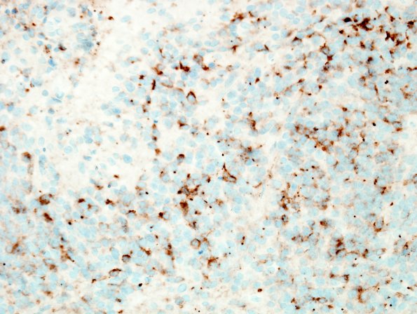 15D1 Ependymoma, anaplastic (Case 15) EMA 2.jpg