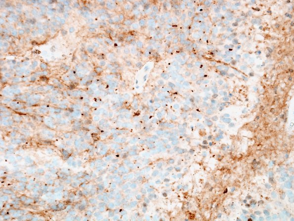 15D2 Ependymoma, anaplastic (Case 15) D2-40 1.jpg