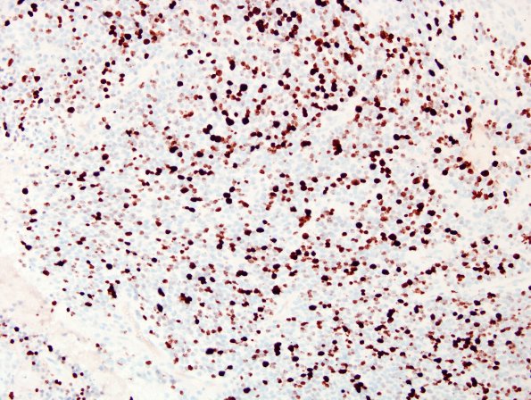 15E Ependymoma, anaplastic (Case 15) Ki67 2.jpg