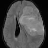 16A1 Ependymoma, anaplastic (Case 16) FLAIR 1 - Copy