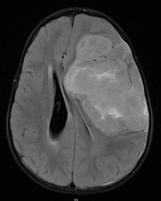 16A1 Ependymoma, anaplastic (Case 16) FLAIR 1 - Copy