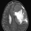 16A2 Ependymoma, anaplastic (Case 16) T2 W 1 - Copy