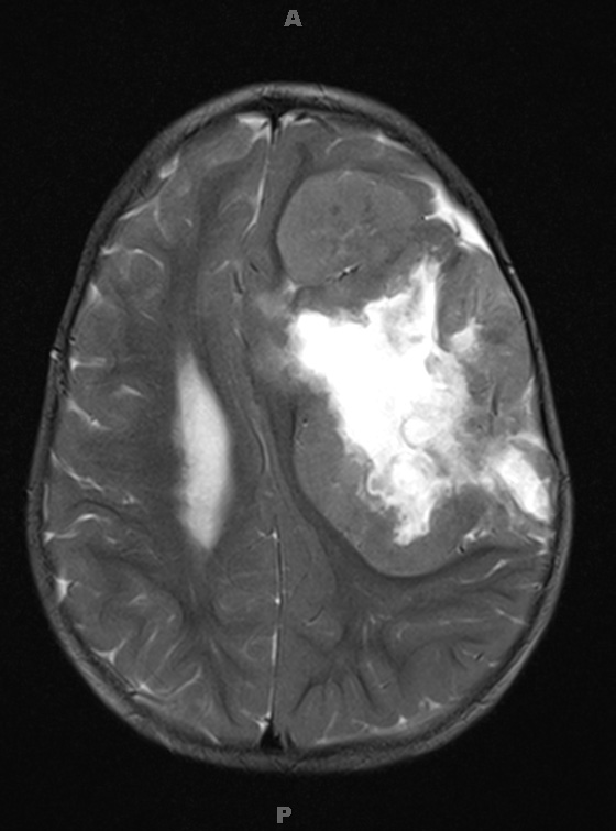 16A2 Ependymoma, anaplastic (Case 16) T2 W 1 - Copy